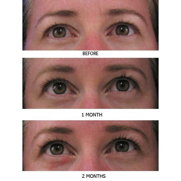 Before, 4-week, and 8-week lash growth results on white woman using MD Lash Factor, showing visibly longer, fuller lashes over time