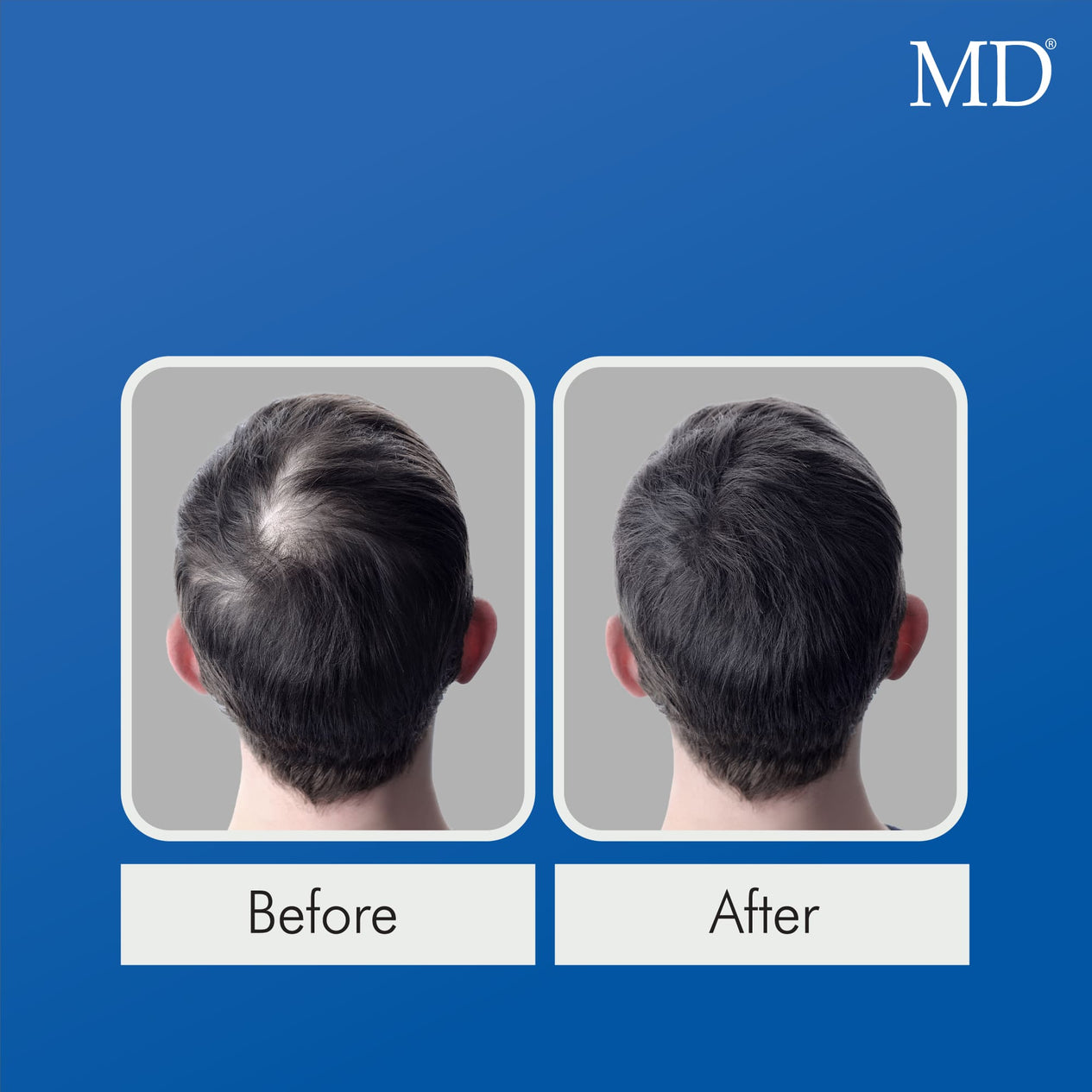 Before and after photo showing visible improvement of bald spot on back of man