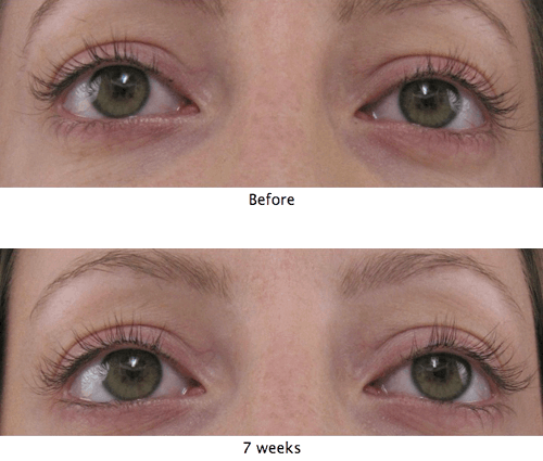 Before and after results from 1-month use of MD Lash Factor lash serum
